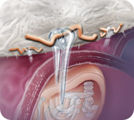 i-FACTOR™ Bone Graft – Enhanced Healing processes for Growth - Medical ...